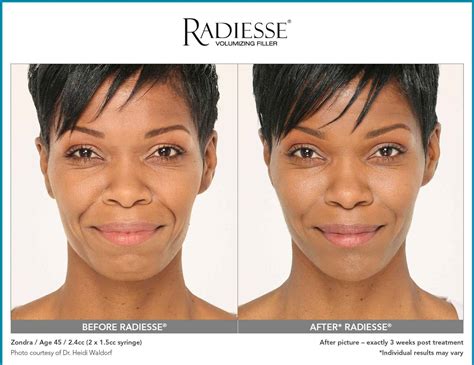Radiesse® Overview: Cost, Recovery, Before & After .